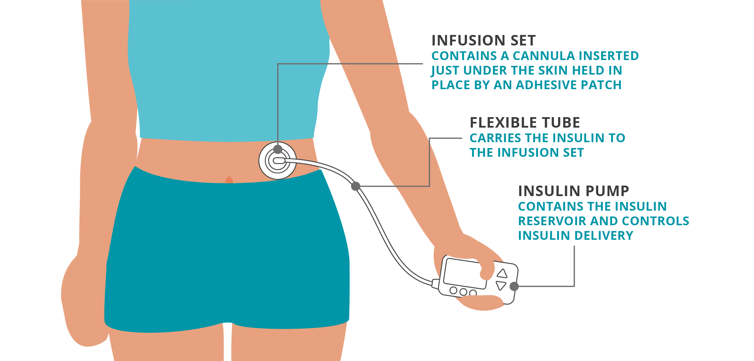 Insulin Pumps: Types & How They Work