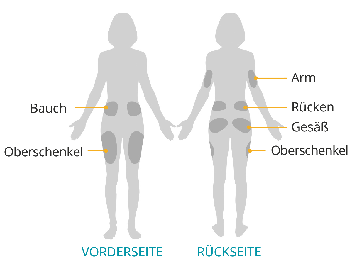 Adult - DE pod placement 