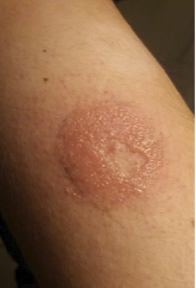 Allergic Contact Dermatitis