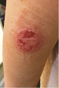 Allergic Contact Dermatitis