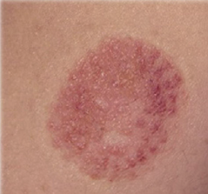 Purpuric eczema