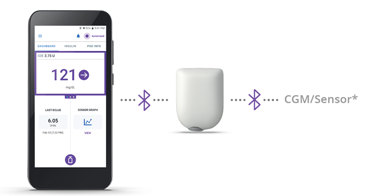 Three components of an automated insulin delivery system: displaying a glucose reading and trend graph, an insulin pump, and a sensor. 